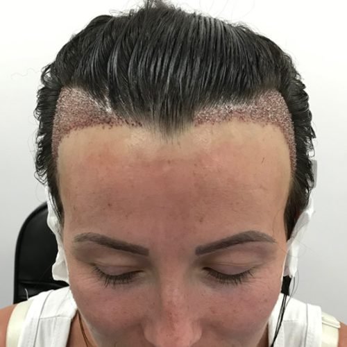 female-hair-transplant-hair-restoration-british-hair-clinic